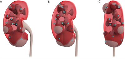 The Small Size and Superficial Location Suggest That Laparoscopic Partial Nephrectomy Is the First Choice for the Treatment of Juxtaglomerular Cell Tumors